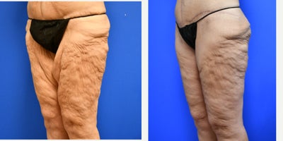45-54 year old woman treated with Tummy Tuck, Thigh Lift - This 49 year old mother of 2 kids was at one point 320 lbs. With a gastric sleeve and help of GLP-1s, she lost half of her body weight.