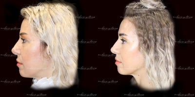 45-54 year old woman treated with Facial Fat Transfer, Eyelid Surgery - This 45-year-old patient underwent Facial Fat Transfer and Eyelid Surgery to achieve a more youthful and refreshed appearance. The facial fat transfer was performed to restore lost volume and enhance facial contours, while the eyelid surgery (blepharoplasty) addressed sagging skin and rejuvenated the eye area. These procedures combined delivered natural and harmonious results, highlighting her facial features. The post-operative results, captured 1 year later, show significant improvements, reflecting both the patients goals and the meticulous approach of the surgical team.
