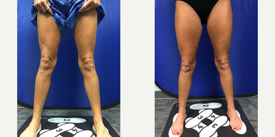 45-54 year old woman treated with EVLT - Patient before and after being treated with Endovenous Laser Ablation on Greater Saphenous Vein and Ambulatory Phlebectomy to remove visible bulging veins
