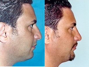 Rhinoplasty and Chin Implant - Enhancement of the chin at the same time as the rhinoplasty is a common procedure to put the face in better balance.