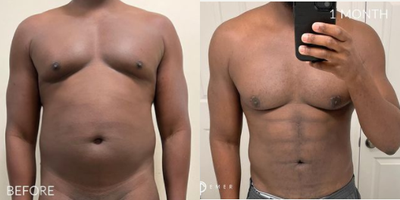 Man treated with Power-Assisted Liposuction (PAL) - Man treated with Vaser Liposuction, Power Assisted Liposuction, Renuvion, and Gynecomastia.