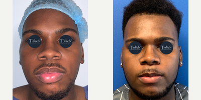 35-44 year old man treated with Rhinoplasty, Alarplasty, Lip Reduction - 35 year old man who underwent open tip rhinoplasty, alarplasty and lip under general anesthesia
