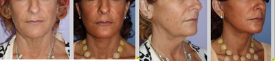 48 year old female, face and neck lift to correct neck and jowls - This 48 year old came to us because she was unhappy with the tired look to the eyes and face.   She was unhappy with her jowls, her neck and the bags under the eyes.&nbsp;