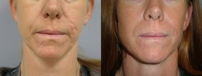 37 Y.O Woman Who Has Facial Scarring Due To a Dog Bite. - This is a 37year-old woman who was concerned about facial scarring due to a dog bite.  She had a scar on the left cheek and on the right side of chin.  She was concerned regarding the depressed nature of the scar and the changes with animation in her face.  She underwent scar revision.  Although still present, the contour irregularities and the puckering with animation had disappeared.&nbsp;