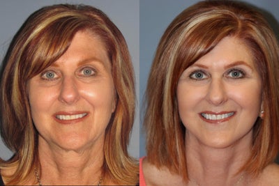 Blue Peel, LiteLift, Platysmaplasty on 57-year-old Woman - 	This 57-year-old woman had a LiteLift, a Platysmaplasy (Neck Lift) and a Blue Peel. Notice the dramatic improvement in her skin tone following her surgical procedure by Dr. Horowitz. In the post-op photos her jawline and chin are now beautifully defined. This patient has a more youthful refreshed appearance. The Blue Peel that was applied post-op reduced fine facial lines.