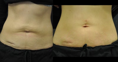 31 year old female patient treated with Exilis Elite for treatment of skin laxity  - 
	31 year old female patient treated with Exilis Elite for treatment of skin laxity
