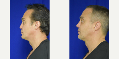 35-44 year old man treated with Revision Rhinoplasty - This patient had a previous rhinoplasty by a general plastic surgeon several years prior. He presented with impressive deformity of the nasal cartilages and collapse of the bridge and tip of the nose. In addition there was severe alar retraction and retraction of the collumella. Revision rhinoplasty was performed to build up the bridge and reposition the tip. The deformed cartilages were straightened and repositioned using specialized surture techniques and cartilage reinforcement grafts. The nostrils were revised to correct the retraction that had occured. The collumella was also grafted to replace the cartilage that had been removed. At 2 months out there is still swelling evident throughout the tip region. This is expected to settle over the next several months and improved tip definition will be realized.
