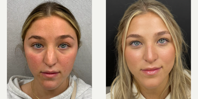 Woman treated with Rhinoplasty - Woman treated with Rhinoplasty