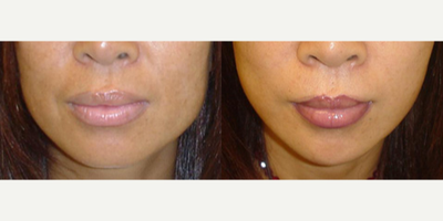 35-44 year old woman treated with Jaw Reduction - 35-44 year old woman treated with Jaw Reduction