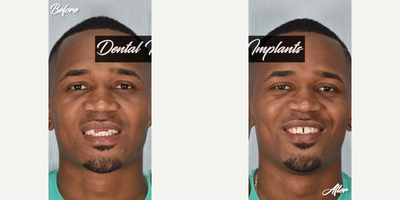 25-34 year old man treated with Dental Implants, Dental Crown, Dental Bone Graft - This patient lost his teeth in an accident when he was 14 years old.