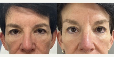 65-74 year old woman treated with Brow Lift - 68 y/o woman, 3 months after brow lift in our office operating room under sedation.