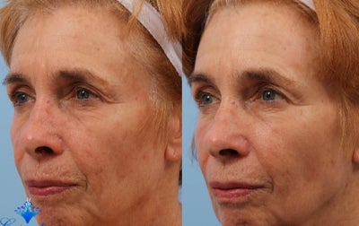 65-74 year old woman treated with Laser Treatment - Improved skin quality after one Pixel fractionated CO2 laser treatment.