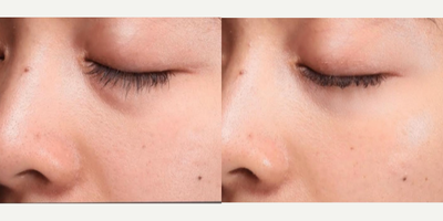 Woman treated with Vampire Facial - If dark under-eye circles are something youve struggled with, just know there are solutions.Our PRP under-eye rejuvenation treatment uses injections of PRP created from a small amount of blood using a centrifuge to separate platelets from red blood cells. Concentrated platelets are then injected into the skin, microneedle, or both to help with various under-eye issues.We typically recommend 3+ sessions to see optimal results but this will vary case by case. Results are best when under-eye treatment is used in conjunction with vampire facial and proper at-home follow-up skin care.