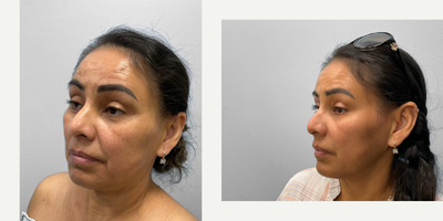 35-44 year old woman treated with Eyelid Surgery - This woman in her mid-forties came to discuss her options for facial rejuvenation with Dr. Tucker. Her concerns centered around droopy upper eyelids and undereye bags. She had excess lid skin with minimal fat making her a good candidate for an upper and lower lid blepharoplasty with ptosis repair. Shown before and five months after, she looks great and has been pleased with her results.