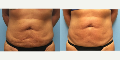 56 year-old woman treated with UltraShape and VelaShape to the abdomen - UltraShape therapy performed on the abdomen.  3 treatments 2 weeks apart.  Post-procedure VelaShape therapy was done as well.  Notice the slimming effects of the UltraShape and skin tightening effects of the VelaShape!