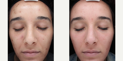 25-34 year old woman with Acne Scars treated with Cosmelan Peel - Patient was concerned with textural and pigmentation irregularities from acne scarring and was treated with a Cosmelan peel to improve texture, color and tone.