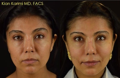 NovaThreads for Non-Surgical Cheek Lift and Corner of Mouth Tightening - This 36 year old female under went a NovaThreads treatment to lift her cheeks and to tighten the area around her mouth and jawline. results demonstrate immediate after results. NovaThreads are dissolvable polydiaxanone (PDO) threads for temporary lifting of the soft tissues of the face. Results may last anywhere from 6-12 months depending on how many threads are placed and how heavy the facial tissues are. Just like with fillers, it is easy to add one or two threads in the office as an enhancement if the effect starts to dissipate more quickly than desired. The procedure is done in the office under local anesthetic. Downtime is minimal to none.