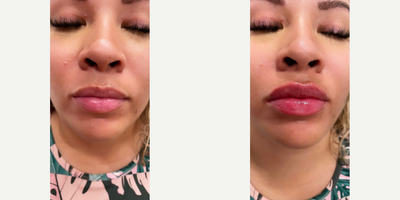 Woman treated with Juvederm - Woman treated with Juvederm XC as lip fillers