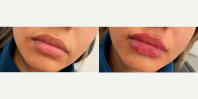 Woman treated with Juvederm - Woman treated with 1ml of Juvederm XC as lip fillers