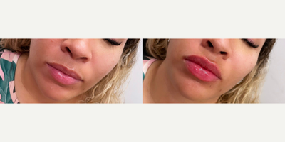 Woman treated with Juvederm - Woman treated with Juvederm XC as lip fillers
