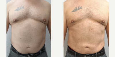 45-54 year old man treated with Liposuction, SAFELipo, Power-Assisted Liposuction (PAL) - 45-54 year old man seeking improved contour to flanks, abdomen, and chest, treated with liposuction body contouring