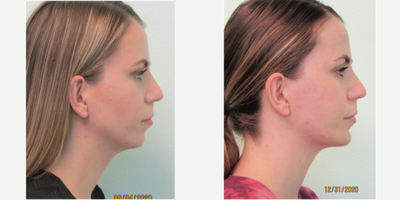 25-34 year old woman treated with Chin Augmentation with Silicone Implant - This young woman presented with the desire to moderately increase the size of her chin. She stated that she did not prefer her profile and lack of definition. She also stated that her nose seemed disproportionately large when compared to her lower facial features.During consultation we decided together that the best plan of action would be to address the issue with placement of a silicone chin implant (Conform extended anatomic implant by Implantech).Under local anesthesia and mild sedation with xanax, we placed the implant from under the chin using an incision less than 1/2 inch in length. These sutures were removed one week later in addition to the majority of her swelling having been resolved at that point in time.Her results show a natural appearing increase in the size of her chin making both for a stronger profile and better balance with her nose.