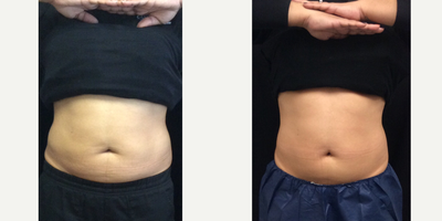 25-34 year old woman treated with Emsculpt - Emsculpt abs before and after