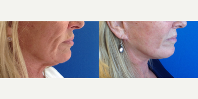 65-74 year old woman treated with Neck Lift - 65-74 year old woman treated with Neck Lift as well as Facelift and Chemical Peel, shown 6 months post op.