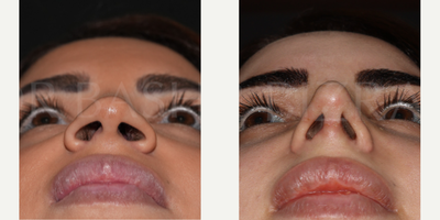 Woman treated with Sinus Surgery - Blocked Nose