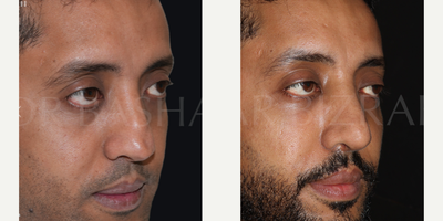 Woman treated with Sinus Surgery - Blocked Nose