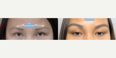 Woman treated with Eyebrow Transplant - Eyebrow Transplant