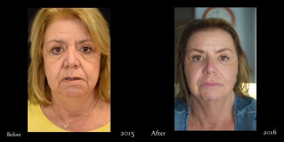 65-74 year old woman treated with CO2 Laser, Fractional Laser, Laser Resurfacing, Nonsurgical Facelift - CO2 Laser resurfacing for full face rejuvenation