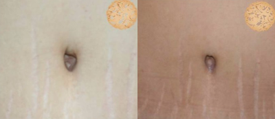 35-44 year old woman treated with Belly Button Surgery - Here is a belly-button revision after another surgeon's tummy tuck.