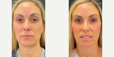 Woman treated with Aquagold - Just 1 Aquagold Fine Touch Treatment:- brighter, more youthful looking skin - smoothed skin texture and diminished enlarged pores - improved skin elasticity around the jowls - diminished fine lines and wrinkles on the neck AQUAGOLD uses 24-carat patented gold plated micro-injection system that painlessly delivers a custom cocktail of solutions into the skin for a whole face rejuvenation!