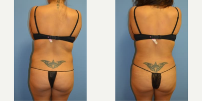 Woman treated with Smart Lipo - Woman treated with Smart Lipo