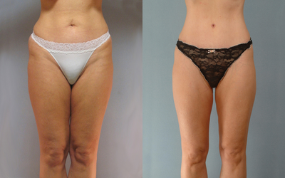 Liposuction - This patient had small pockets of fat in her abdomen that she wanted to get rid of. Dr. Newall performed tumescent liposuction to give her the shape she desired.