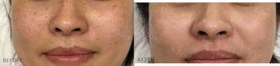 35-44 year old woman treated with PicoSure - Freckle removal with Picosure, a relatively painless treatment that improves the tone of your skin to create a more uniform appearance.