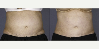 45-54 year old woman treated with Liposonix - 45-54 year old woman treated with Liposonix