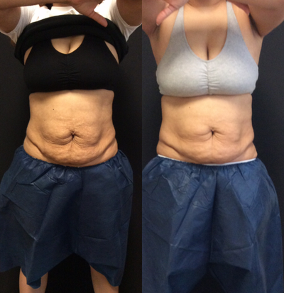 55-64 year old woman treated with Venus Legacy - CoolSculpting and Venus Legacy
