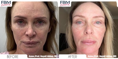 45-54 year old woman treated with Deep Plane Facelift, Neck Lift, Eyelid Surgery, Facial Fat Transfer, Brow Lift - 45-54 year old woman treated with Deep Plane Facelift, Neck Lift, Eyelid Surgery, Facial Fat Transfer, lateral brow Lift
