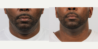 45-54 year old man treated with CoolMini - 48 year old male. Had 2 sessions of CoolSculpting with CoolMini, done 4 weeks apart. Treated right and left submental, overlapped mid submental. Post pictures are at 3 months from second session.