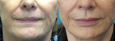66 year old woman treated with Volbella - This patient was concerned with loss of volume and lines setting in on her lips