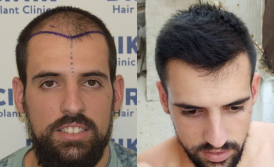 Man treated with FUE Hair Transplant - Man treated with FUE Hair Transplant using 3,400 grafts for frontal and middle hairline area, shown 10 months post op.
