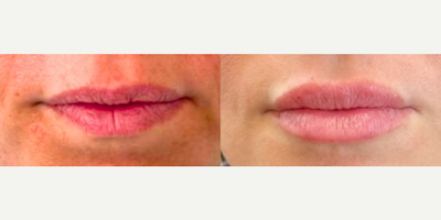 Woman treated with Juvederm - Woman treated with Juvederm