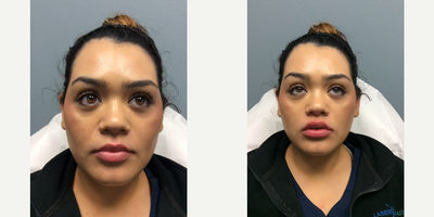 Woman treated with Juvederm - Woman treated with Juvederm