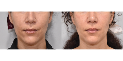 Dynamic Smile Lines Treated with Refyne - This patient noticed lines around the mouth with smiling. Refyne was used to soften lower facial creases when smiling. Lines present at rest (non-smiling) were also less noticeable after treatment with 1 cc of Refyne. After photos were taken two weeks post injection.