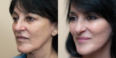 45-54 year old woman treated with Eyelid Surgery - Karin traveled to the States from South Africa where she underwent an Upper Blepharoplasty along with a Facelift. Her appearance is both natural and more refreshed following her Facelift and her upper eyelid surgery.