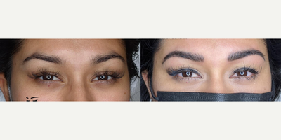 Woman treated with Microblading - Woman treated with Microblading