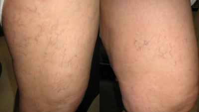 Woman treated with Excel V - Woman treated with Excel V