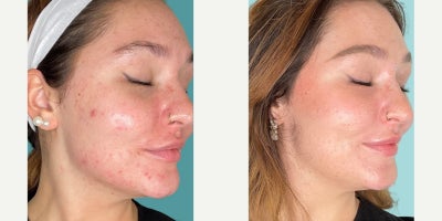 Woman treated with VI Peel - Transform your skin in 7 days with the ultimate peel for a radiant, youthful complexion! Experience the glow and brightness and have the healthiest skin youve ever wanted.